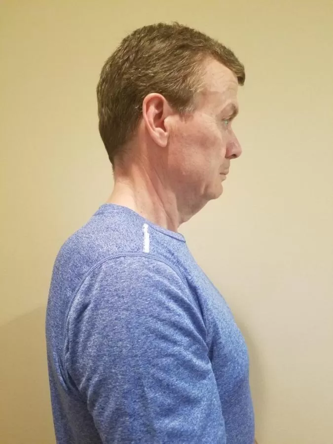 Chin Tuck Exercise